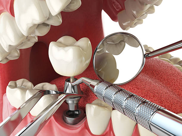 Best Emergency Dental Care for Broken or Chipped Teeth in Rising Sun, MD